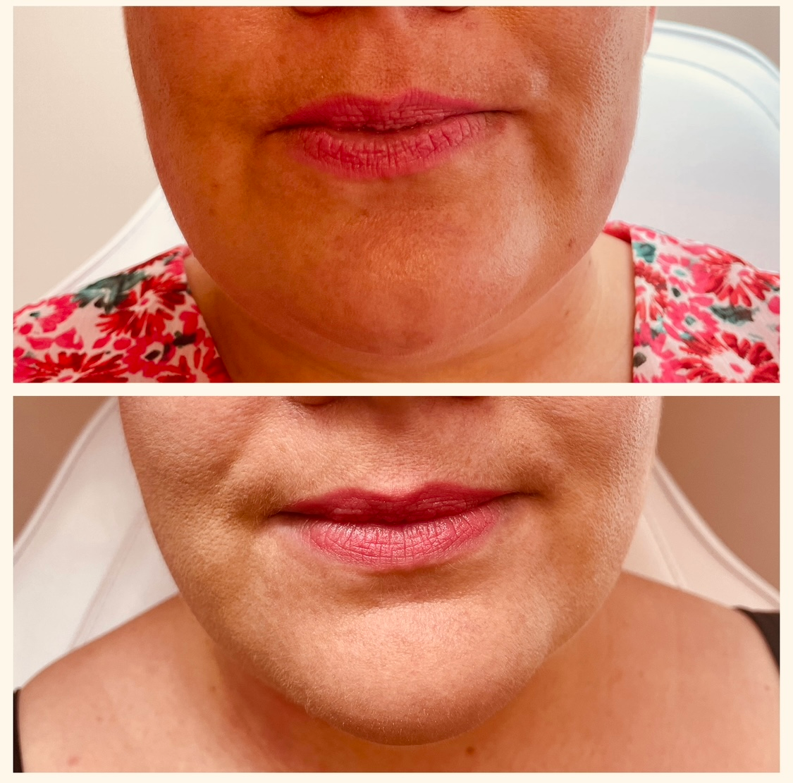 Masseter / Jaw Slimming Treatments