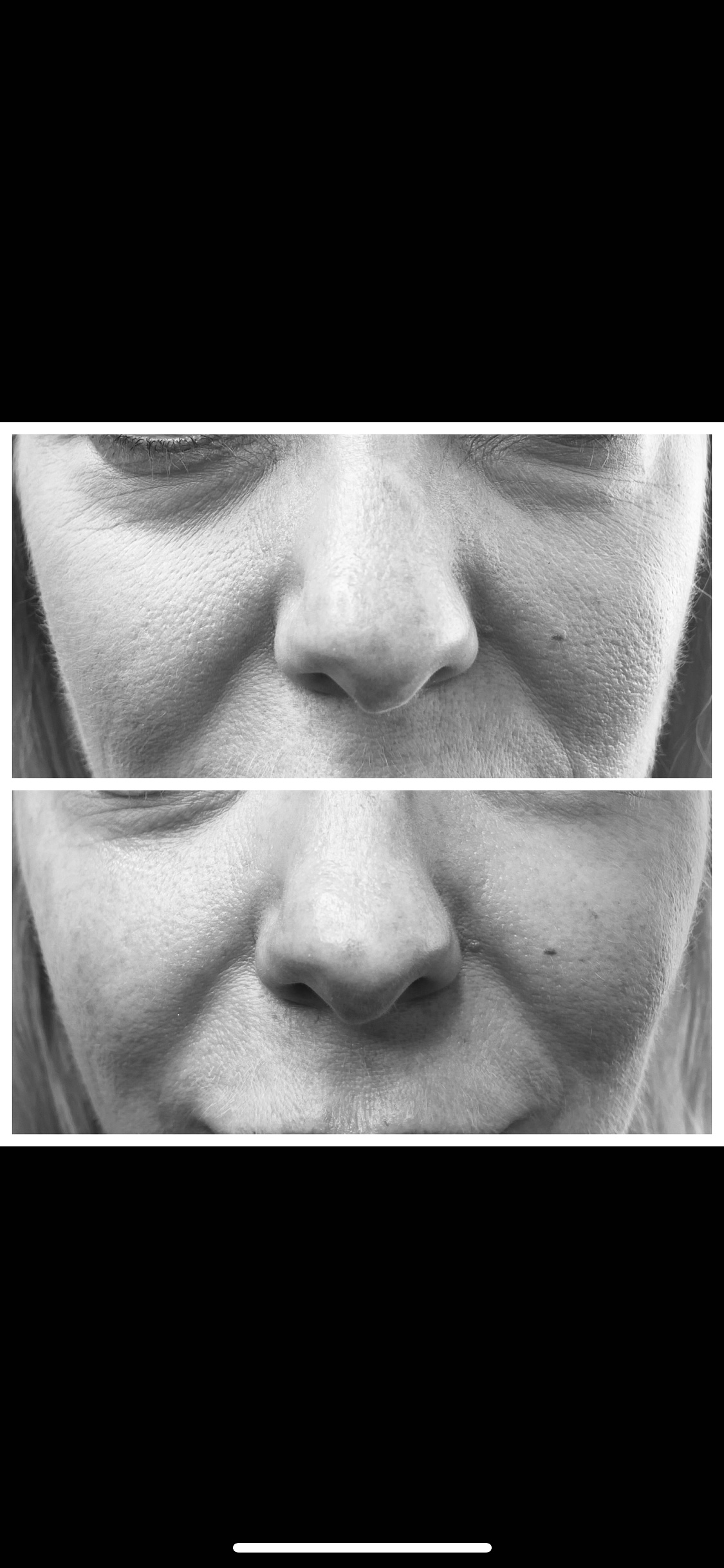 Cheek Filler Treatments