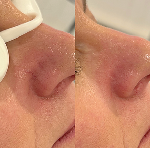 Before and After Image demonstrating results of Diode laser for the ttreatment of Vascular Lesions of the Nose