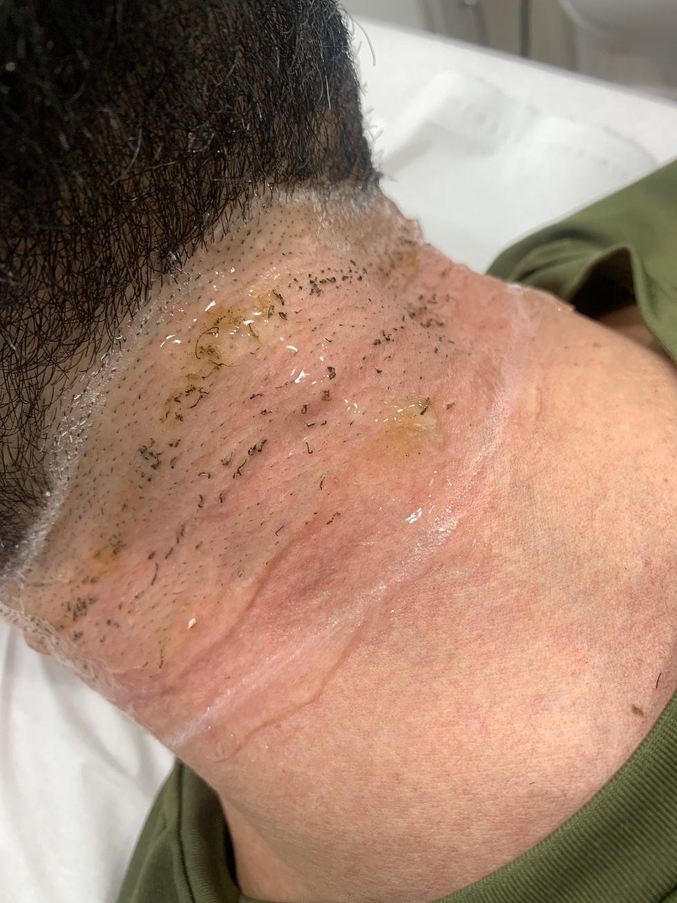 Thumbnail: Before and after laser hair removal of the neck