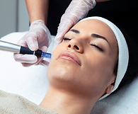 Microneedling at New Age Aesthetics