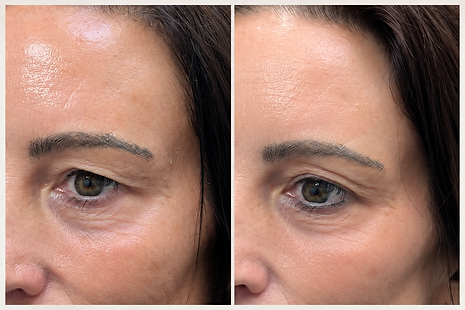 Plasma Pen eye treatment before and after results