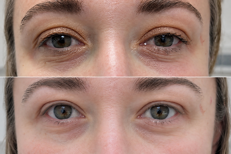 Before and after skin booster treatment showing improved skin quality