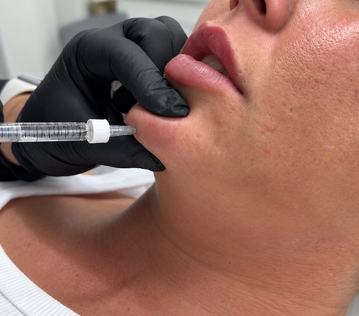 Facial dermal filler treatment for balanced facial contours