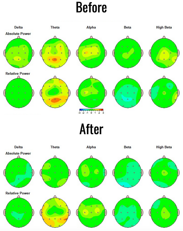 QEEG brain mapping and neurofeedback benefits