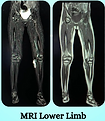 MRI Lower Limb