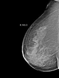 Digital Mammography Test Right Breast