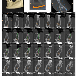 CBCT Quadrant