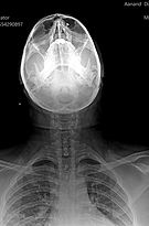 Digital Xray PNS