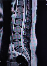 mri-ls-spine
