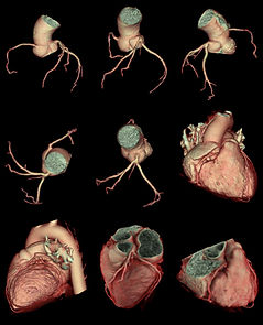 CT Coronary Angiography test