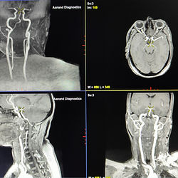 MRI Brain Neck Vessels Angiography