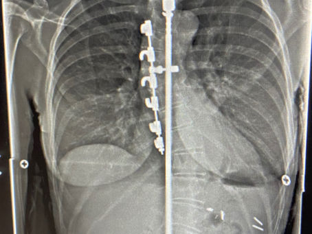 Still Moving Forward: A Pilates Teacher's Journey from Scoliosis Surgery to Living Fully with Lumbar Stenosis