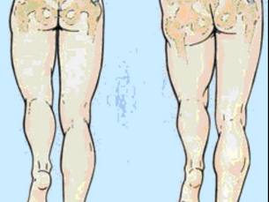 "Hip Drop", What is it and What to do?