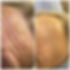 Forehead wrinkle treatment at Leeds Aesthetics Clinic.