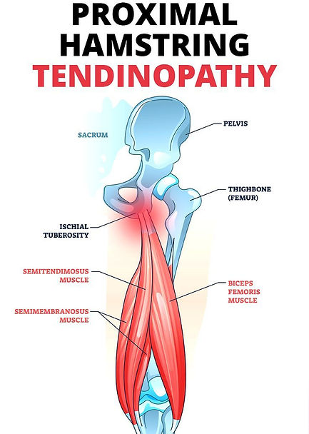 proximal hamstring tendiopathy (PHT)