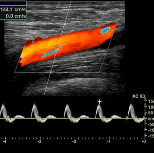 Vascular Doppler Ultrasound