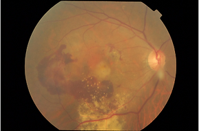 Macula degeneration.webp
