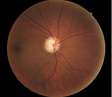Glaucoma.webp