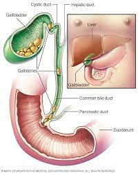 Gall Bladder Stone Complications