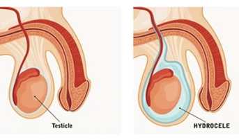 Hydrocoele.png