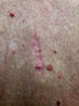 The Skin Check That Saved My Life
