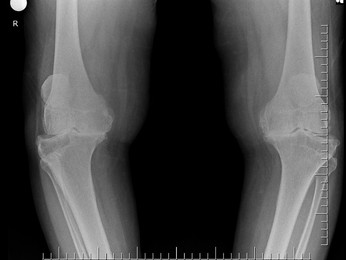 Knee OA Risk Reduces With Return to Pivoting Sports