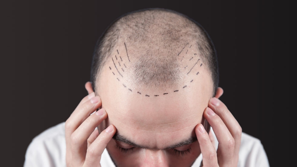 Hair Transplantation