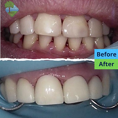 Composite Buildup Before and After .png
