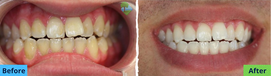 Whitening - Invis Before and After (1080 x 500 px).png