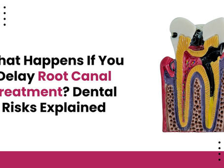 What Happens If You Delay Root Canal Treatment? Dental Risks Explained