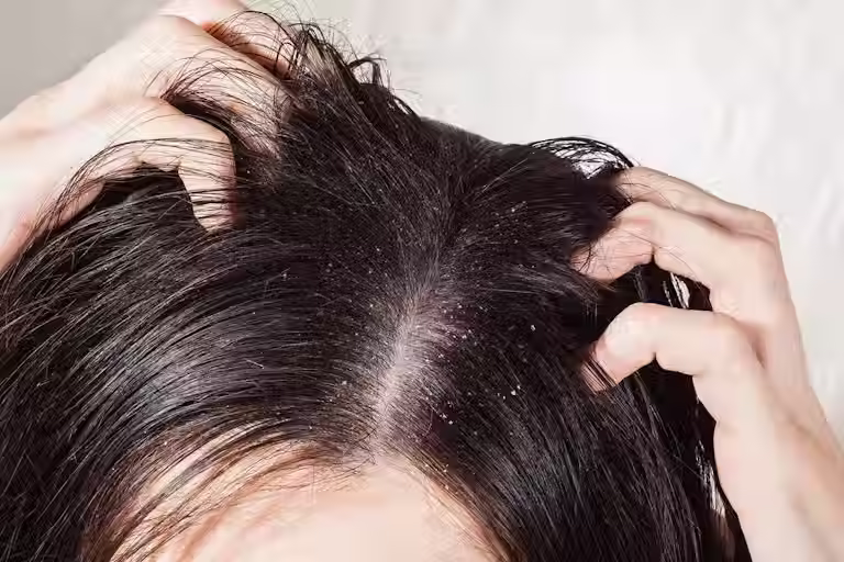 Scalp with dandruff being scratch