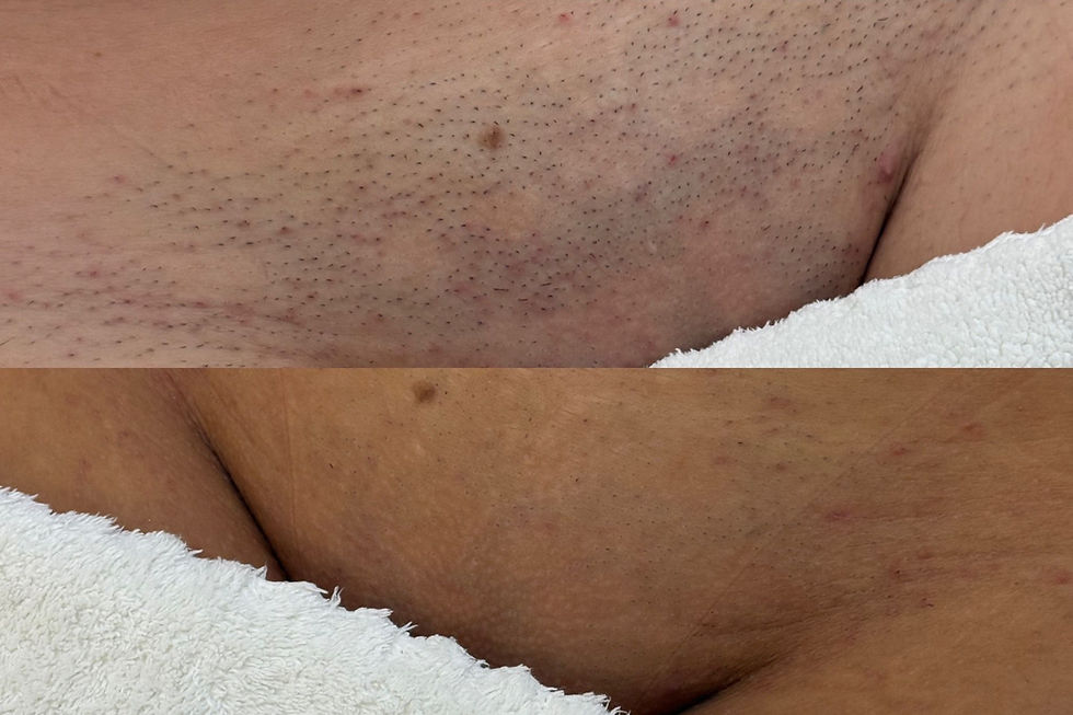 Bikini line laser hair removal results