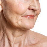 A mature lady with significant skin laxity