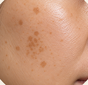 Individual spots or clusters of pigmentation