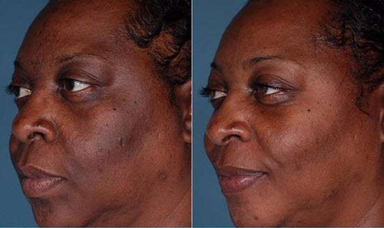 retinol on dark skin