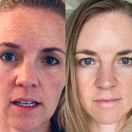 Microneedling Results.jpeg