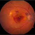 picture of retina with macular degeneration