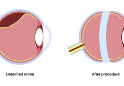 schematic of scleral buckle placed on the eye to repair a retinal detachment