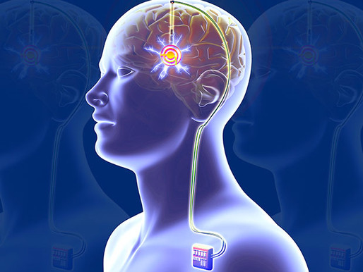 La estimulación cerebral profunda funciona (casi siempre) para tratar la depresión