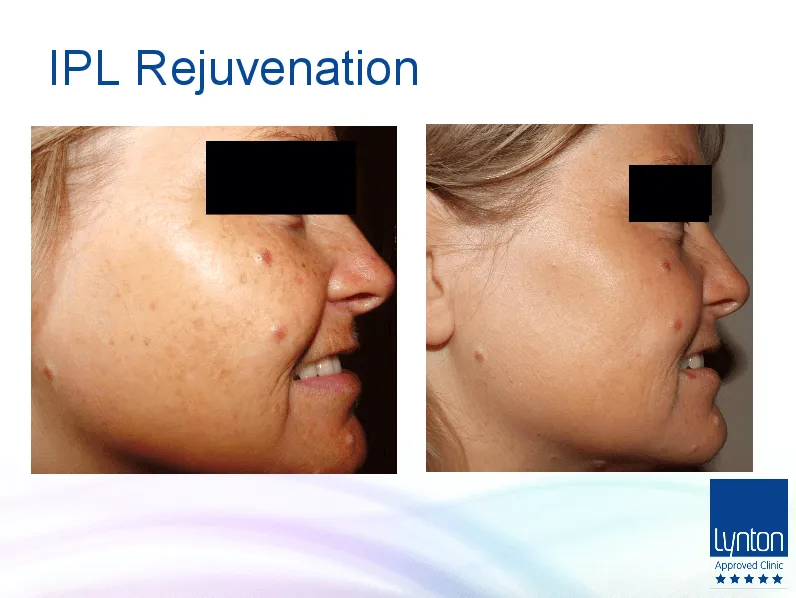 IPL Skin Rejuvenation Lynton