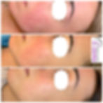 Rosacea Treatment
