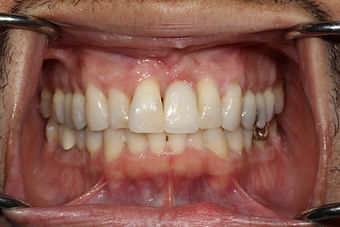 implant 2.JPG