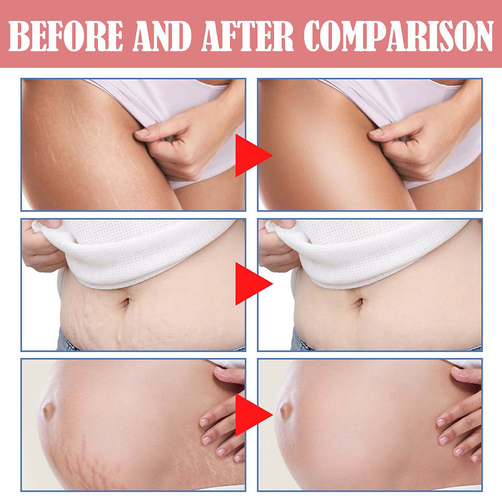 Thumbnail: 2026 Stretch Mark Removal Cream Permanently Removes Stretch Marks Rejuvenates Sk