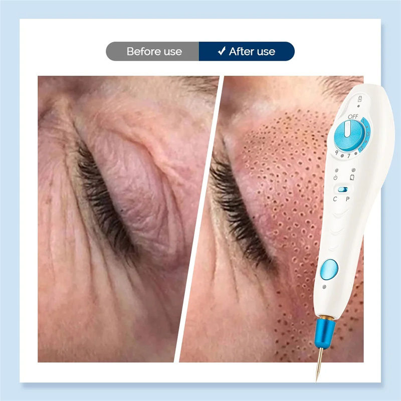 Thumbnail: UBilli Professional Fibroblast Plasma Pen Eyelid Skin Face Lift Acne Mole Spot R