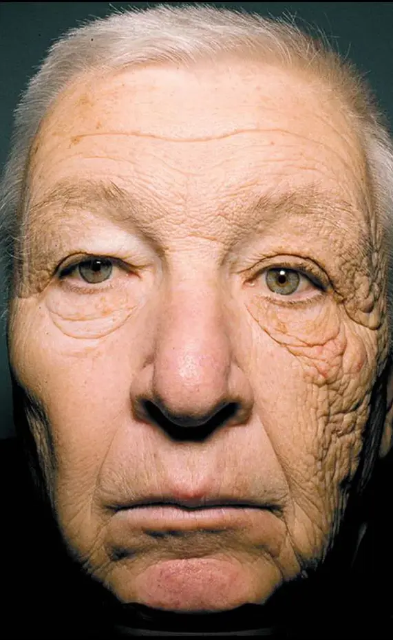 Photo 1. Unilateral facial photoaging in a truck driver after 28 years of chronic ultraviolet (UV) exposure through a vehicle window. Image reproduced from "Trucker accumulates skin damage on left side of his face after 28 years on the road." Available at: https://www.cbsnews.com/news/trucker-accumulates-skin-damage-on-left-side-of-his-face-after-28-years-on-the-road/