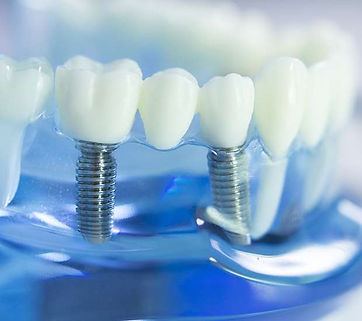 dental-implants.jpg
