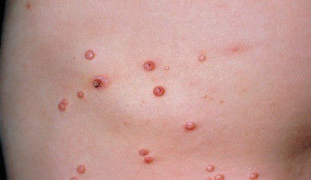 Molusco contagioso.jpeg