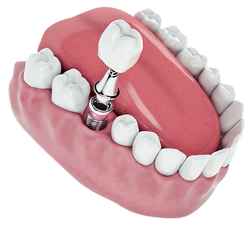 dentistas coronas 