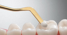 resinas-dentales.jpg